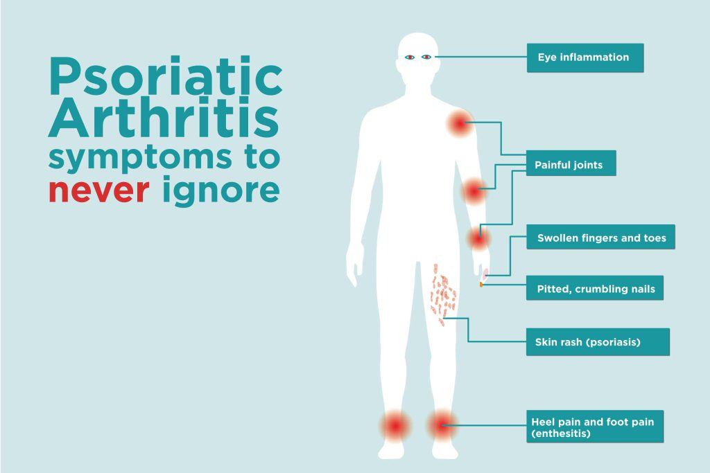 Symptoms of Psoriatic Arthritis