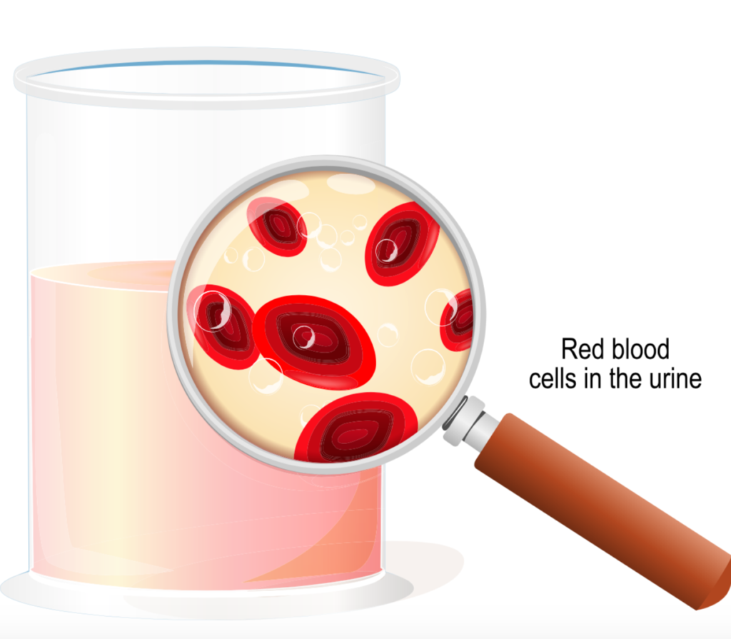 Hematuria - A common symptom of IgA Nephropathy