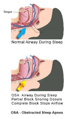 obstructive sleep apnea