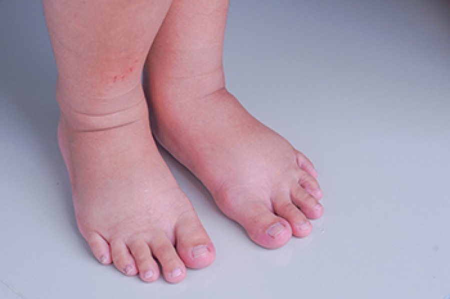 salt accumulation and fluid retention during pregnancy