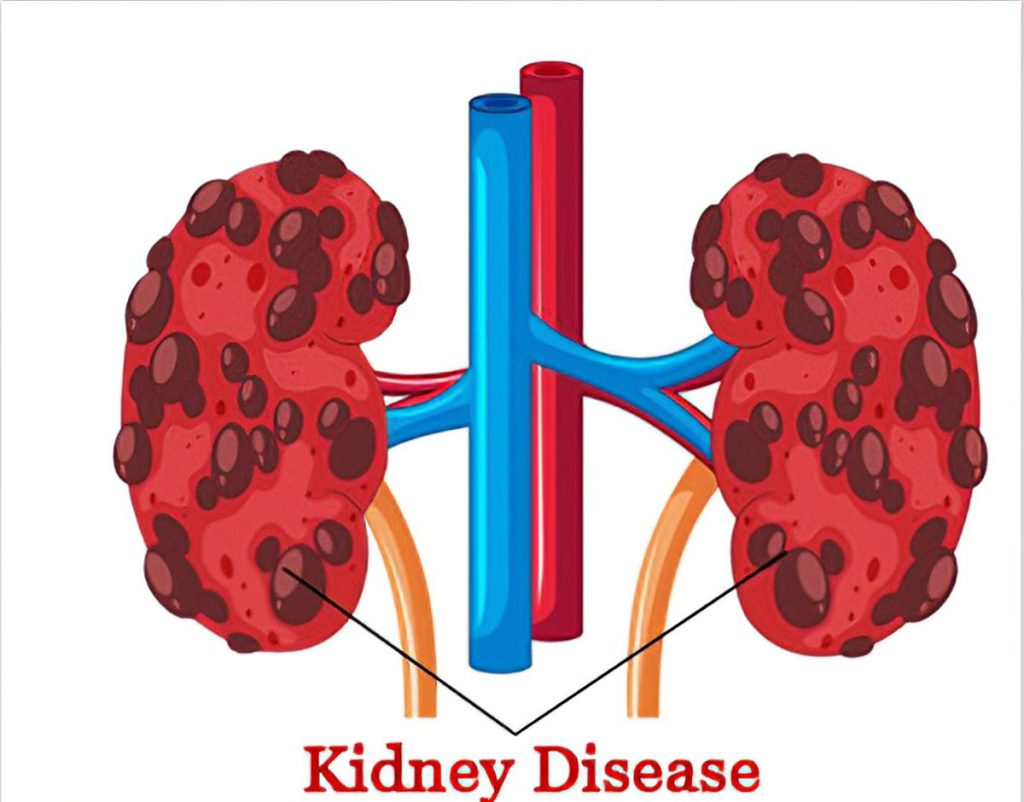 Kidney diseases